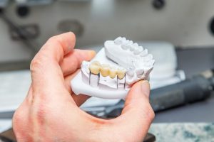 بریج دندان چیست