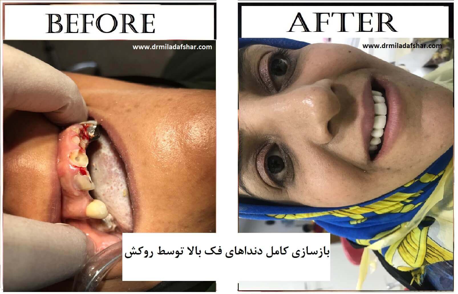 قبل و بعد از بازسازی دندان