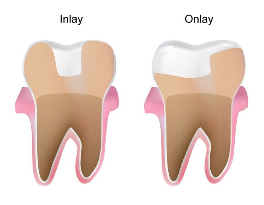 تفاوت اینله و آنله دندان