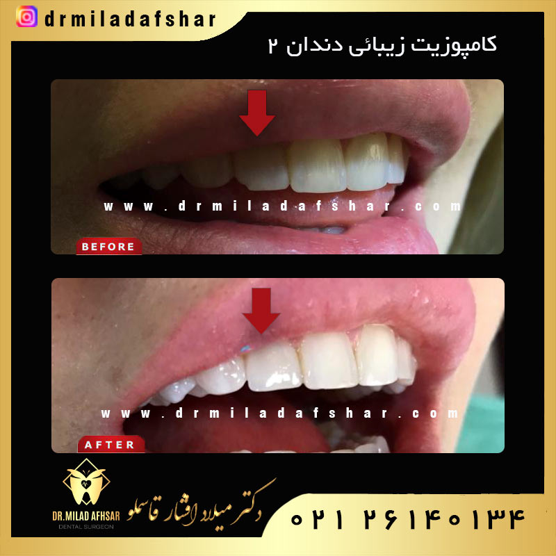 عکس قبل و بعد از کامپوزیت دندان