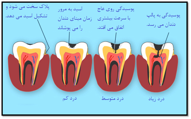 چگونه دندان پوسیده می شود