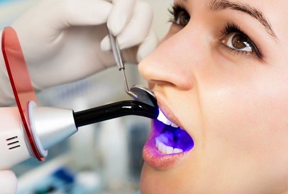 سفید کردن دندان با اشعه آبی 