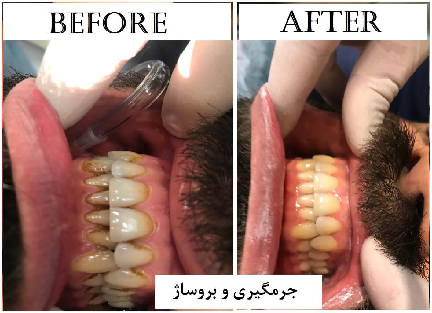 قبل و بعد از جرمگیری دندان