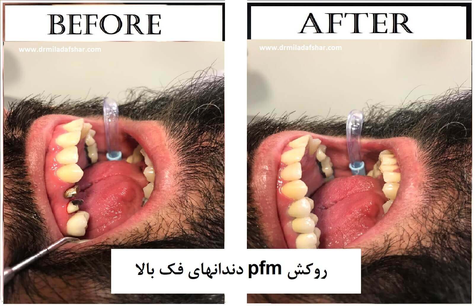 عکس قبل و بعد از روکش دندان