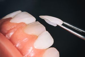 انتخاب لمینت دندان