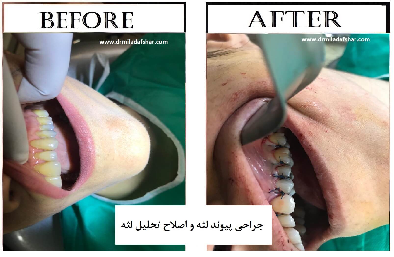 قبل و بعد از جراحی لثه