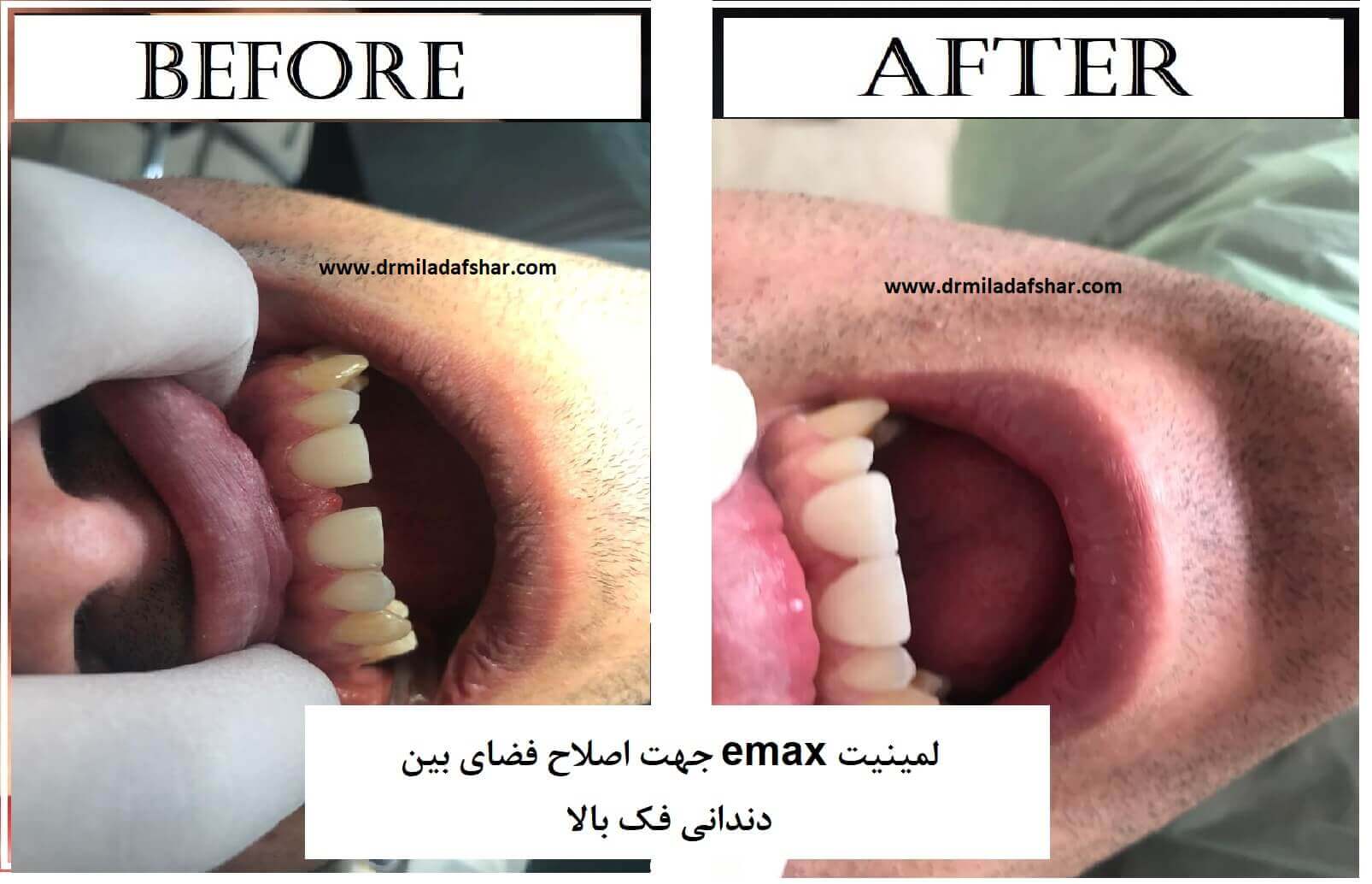 قبل و بعد از رفع فاصله بین دندان ها