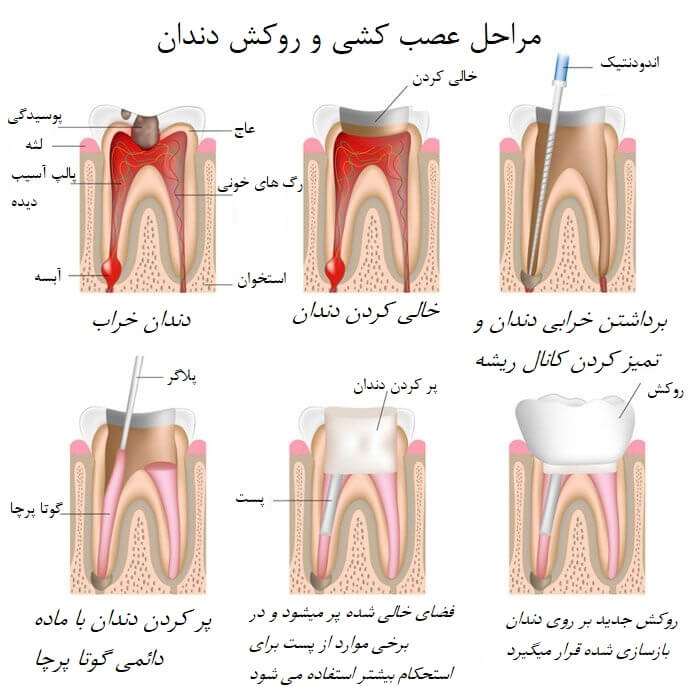 مراحل عصب کشی و پرکردن دندان تصویری