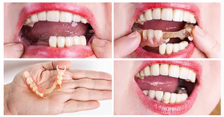 قرار دادن دندان مصنوعی ژله ای