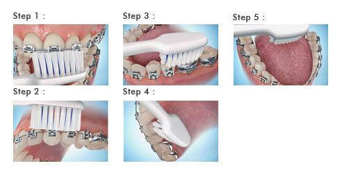 مراحل مسواک زدن دندان ارتودنسی