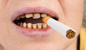 اثرات سیگار بر روی دهان و دندان