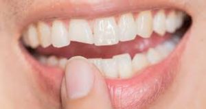 درمان تیزی دندان نیش