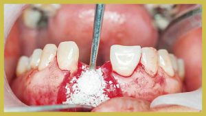 قطع فوری خونریزی دندان بعد از کشیدن