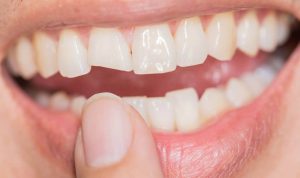 تصویری از دندان قبل از کامپوزیت ونیر یا ارتودنسی