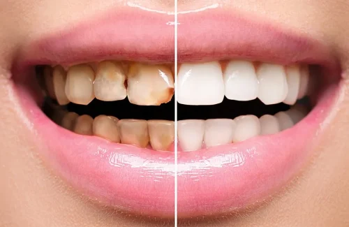 teeth-before-and-after